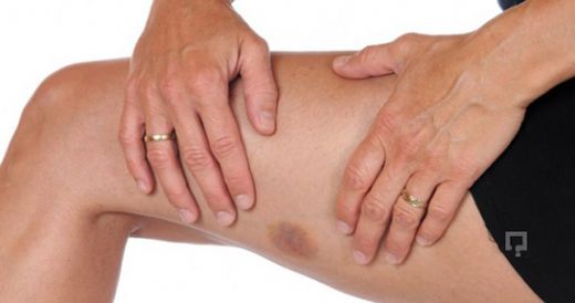 Bacak Seğirmesi Neden Oluşur?