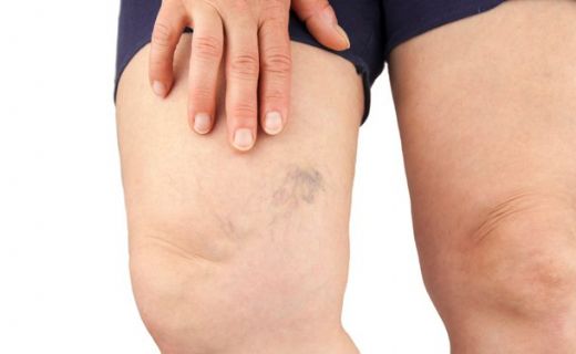 Damar Seğirmesi Belirtileri ve Tedavisi