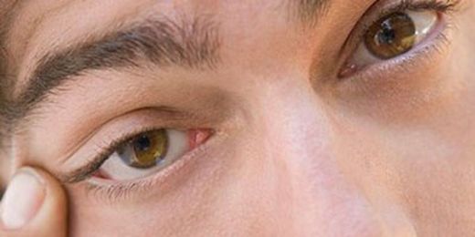 Sağ Göz Kapağı Seyirmesi Neden Oluşur?